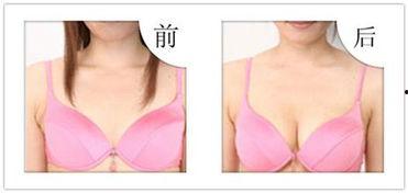 国产隆胸假体介绍视频,创新科技，重塑自信之美  第2张