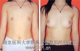 国产隆胸假体介绍视频,创新科技，重塑自信之美  第3张